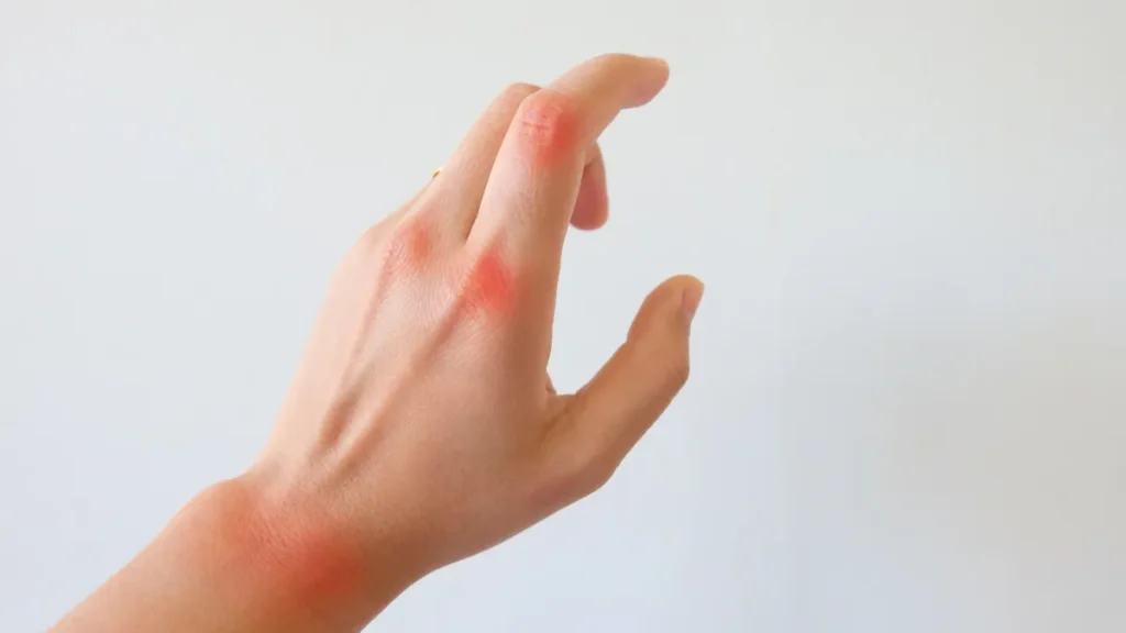 Incapacidad Permanente por Artritis Reumatoide